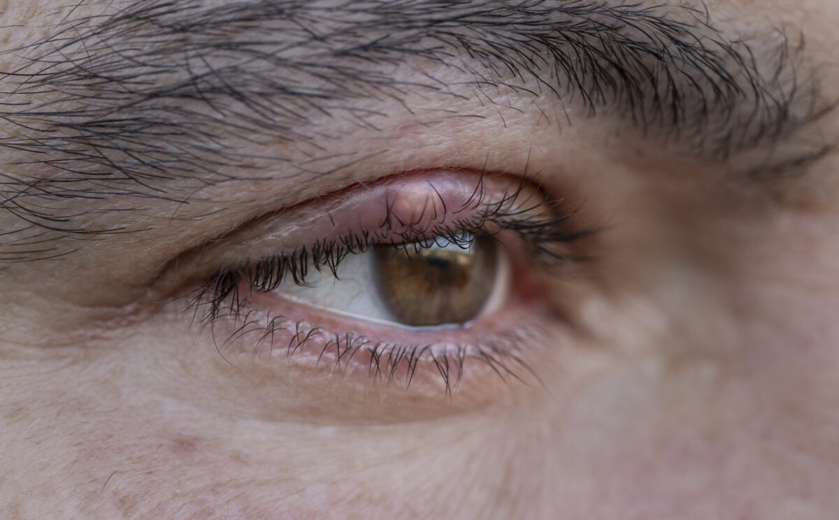 Wie Sie ein Gerstenkorn am Auge loswerden › Gesundheitsoptik